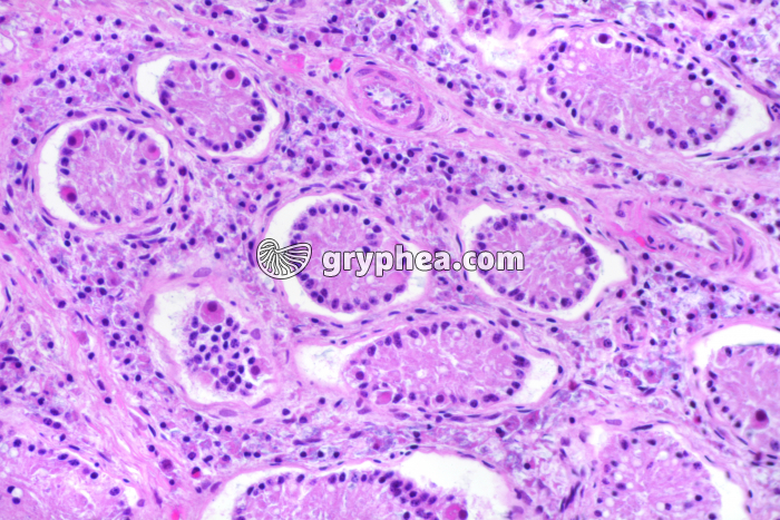 Testicule cryptorchide x100 - gryphea.org